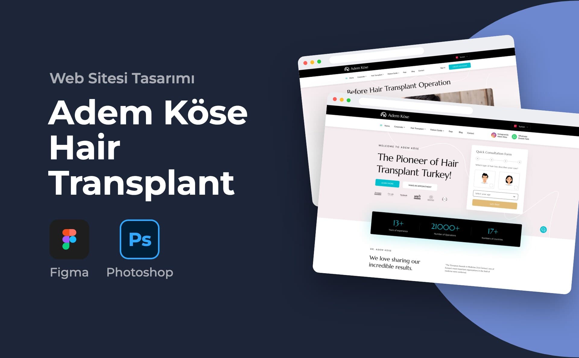 Adem Köse Hair Transplant